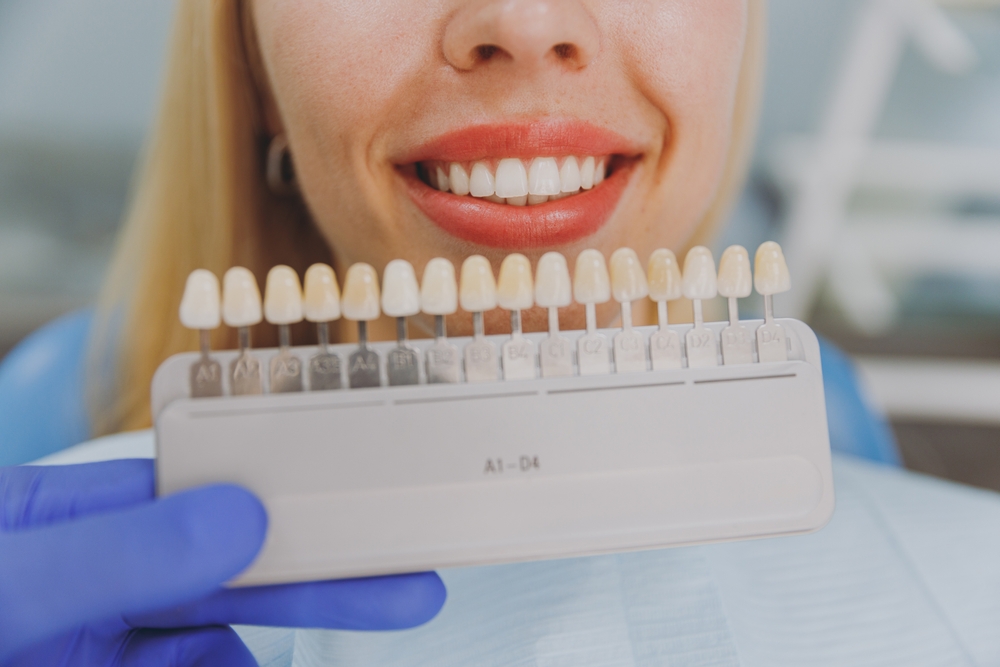 Dental Veneers in Montrose